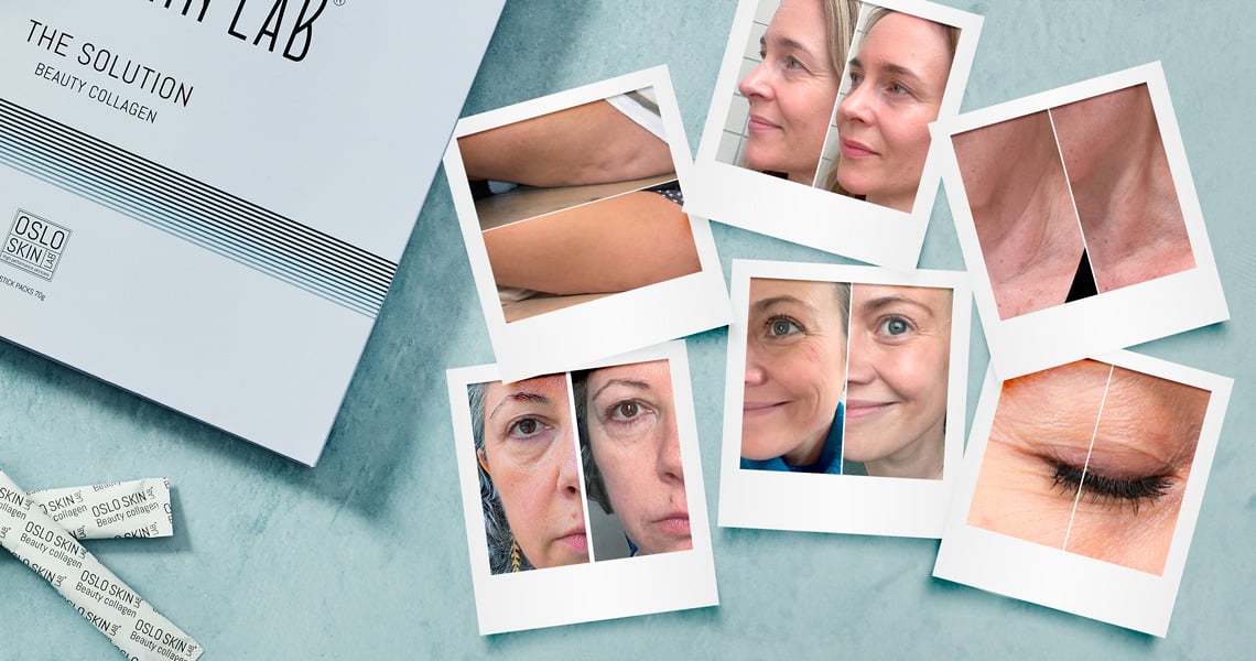Photos avant après de clientes The Solution Beauty collagen